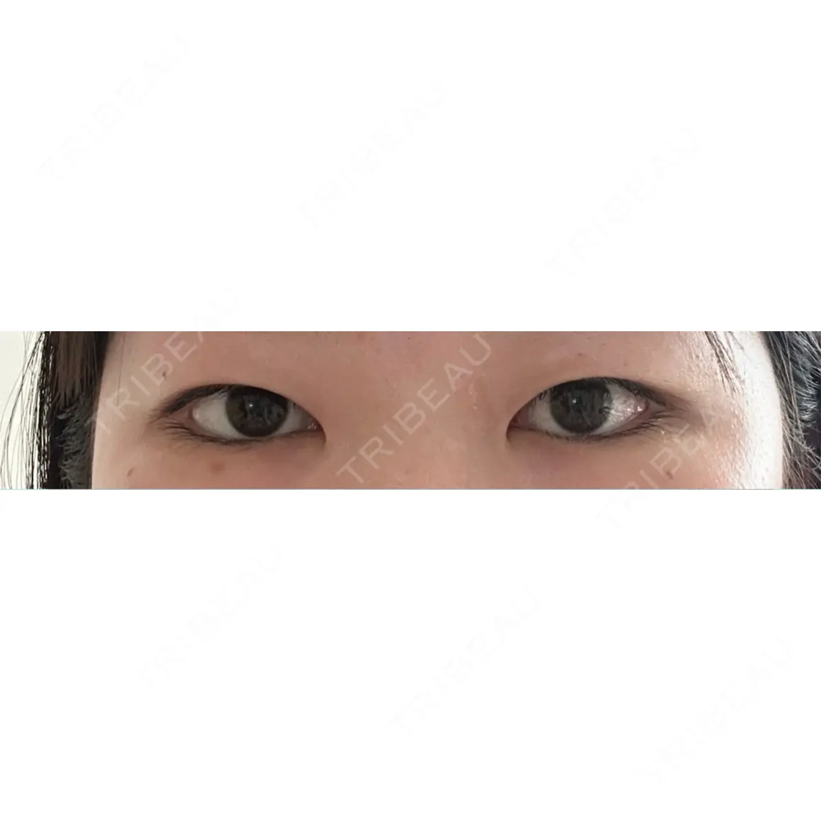 目頭切開 9BeautyClinic AFTER