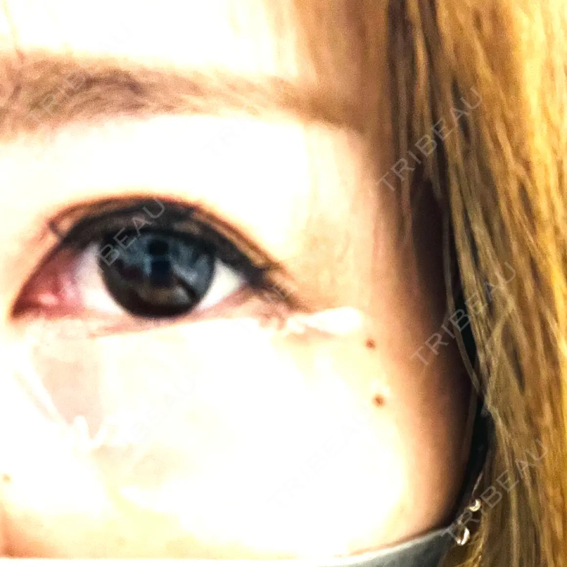 ボトックス（目尻） TCB東京中央美容外科 川越院 AFTER
