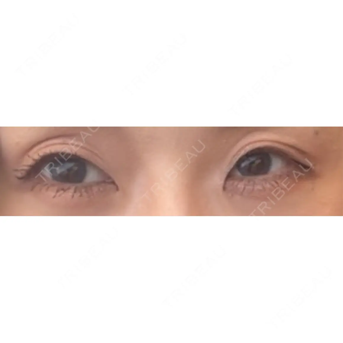 二重埋没 Stand by Beauty Clinic AFTER