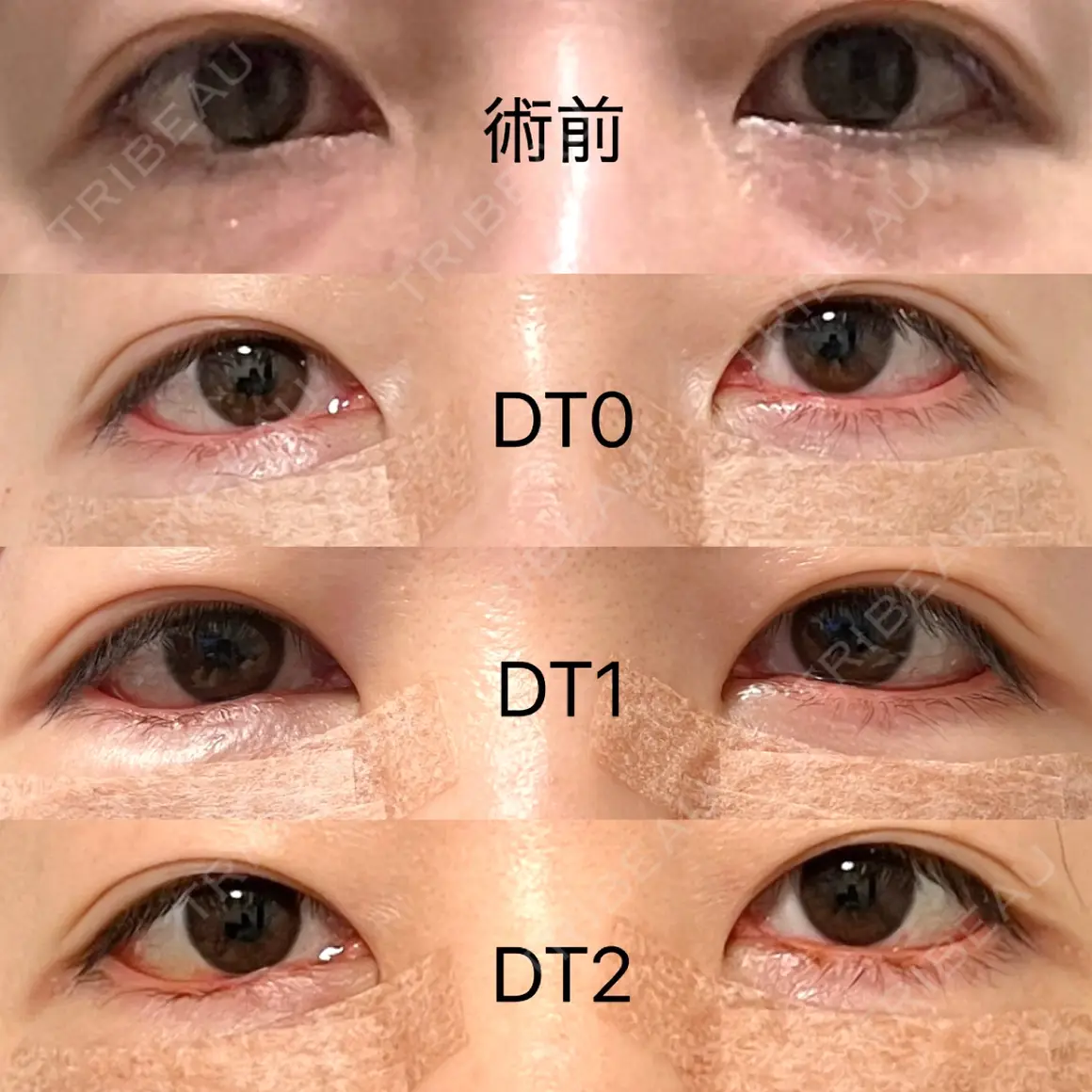 クマ治療 EMMO FACE CLINIC 東京三田院 AFTER