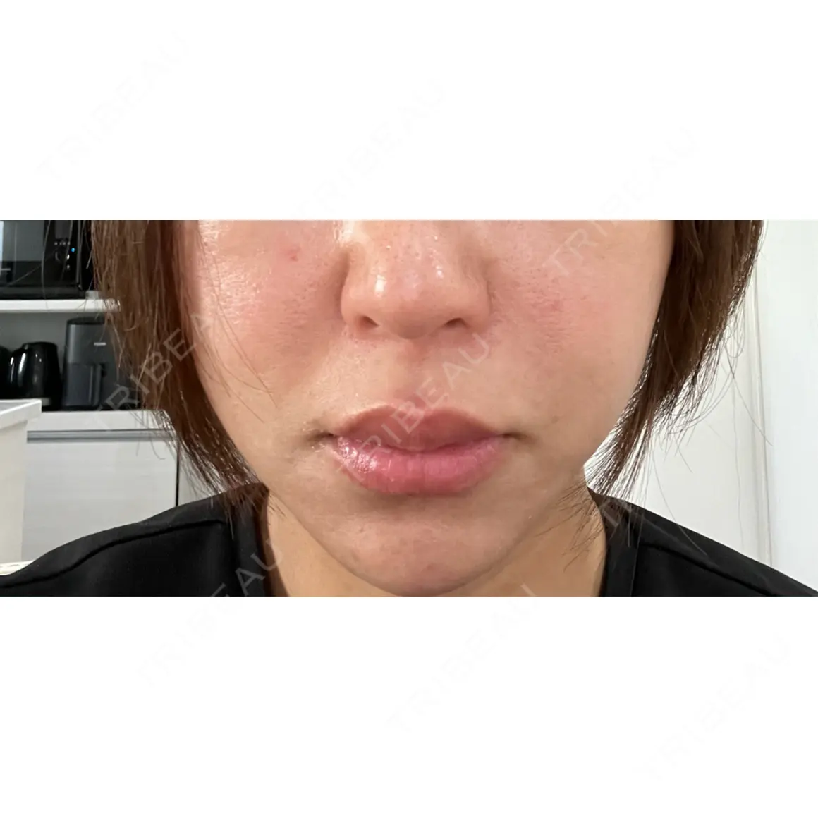 イオン導入 / ルメッカ Grias clinic （ジリアスクリニック） AFTER