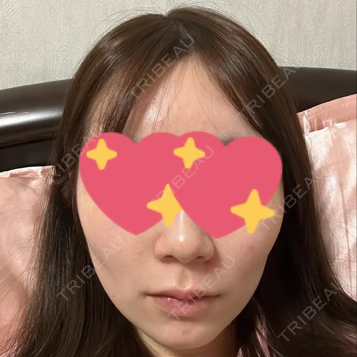 ヒアルロン酸注入（頬） ルラ美容クリニック 名古屋本院 AFTER