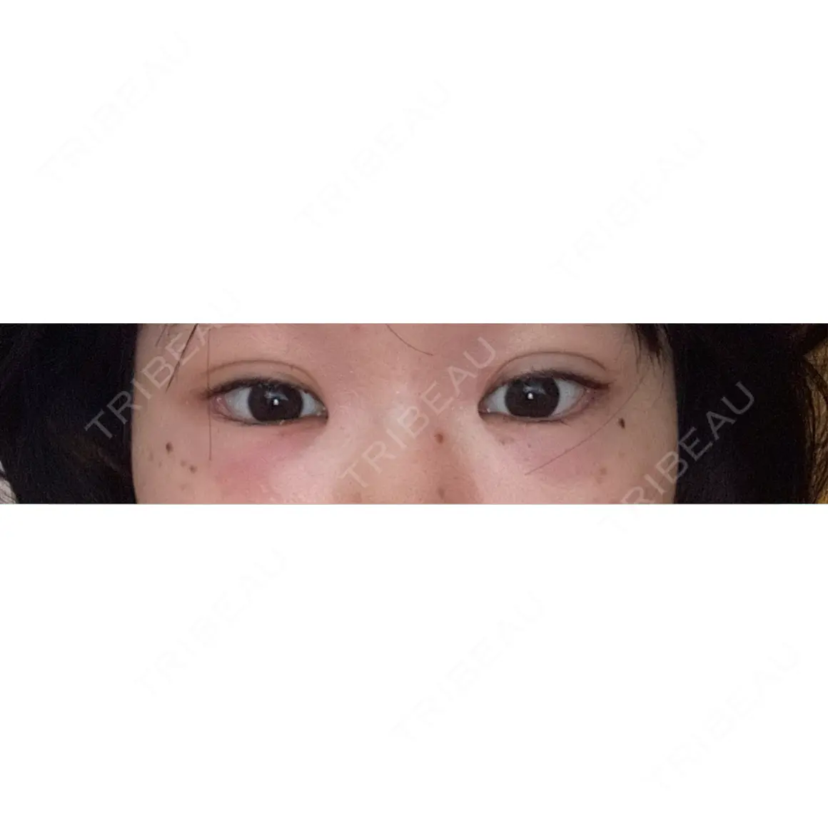 タレ目形成・グラマラスライン（切開） 9BeautyClinic AFTER