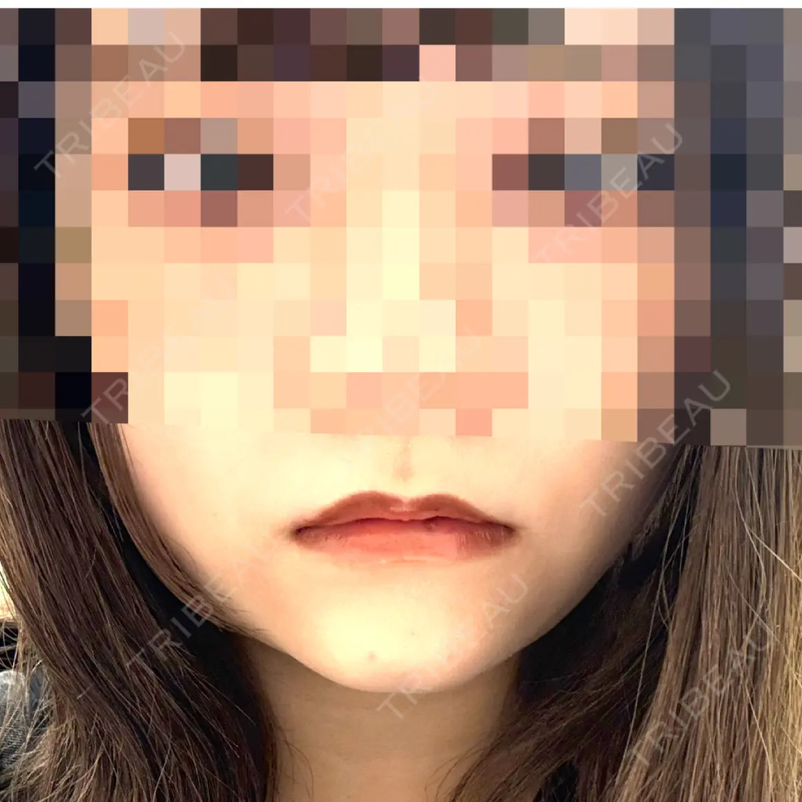 ヒアルロン酸注入（唇） ルラ美容クリニック 横浜院 AFTER