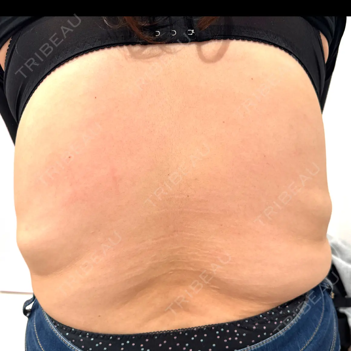 脂肪溶解注射 Natural Skin Clinic 笹塚院 AFTER