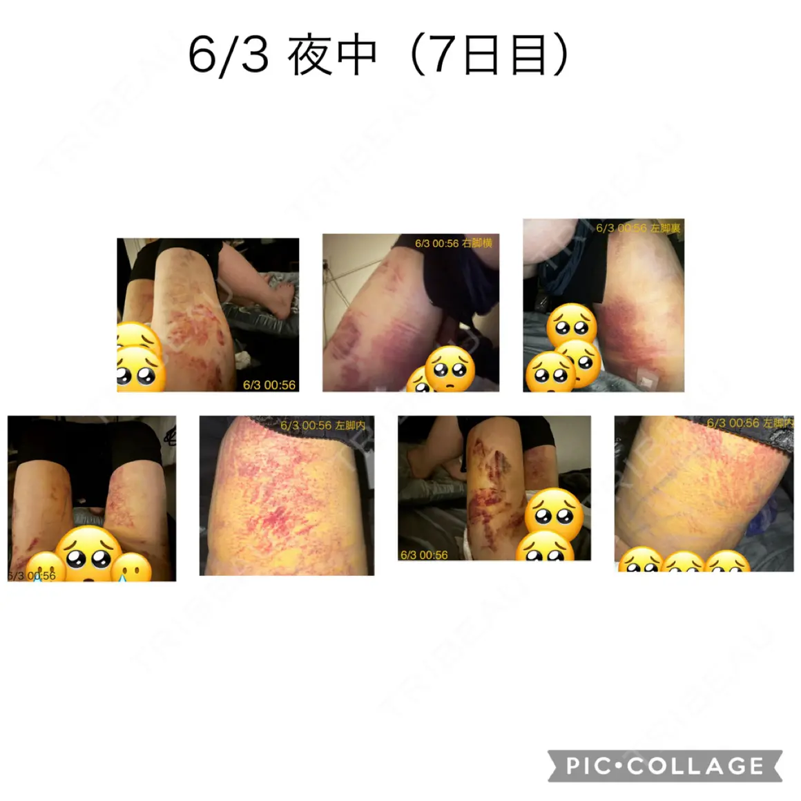 脂肪吸引（脚） / 豊胸（脂肪注入） オアシス美容外科 AFTER