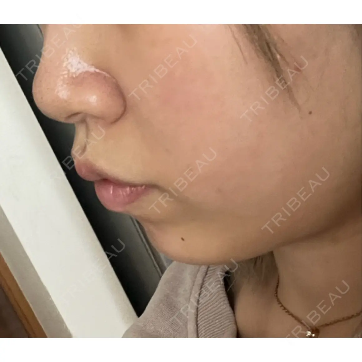ヒアルロン酸注入（あご） / ヒアルロン酸注入（鼻翼基部） / RF（高周波）たるみ治療 gift clinic AFTER
