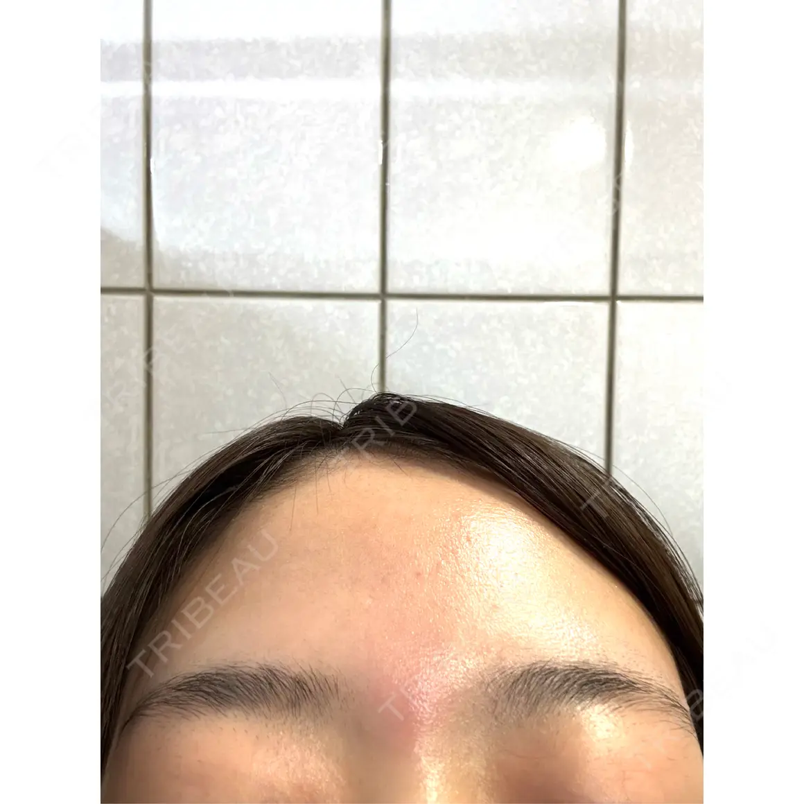 医療脱毛（顔） おおかみ美容のクリニック 新宿院 AFTER