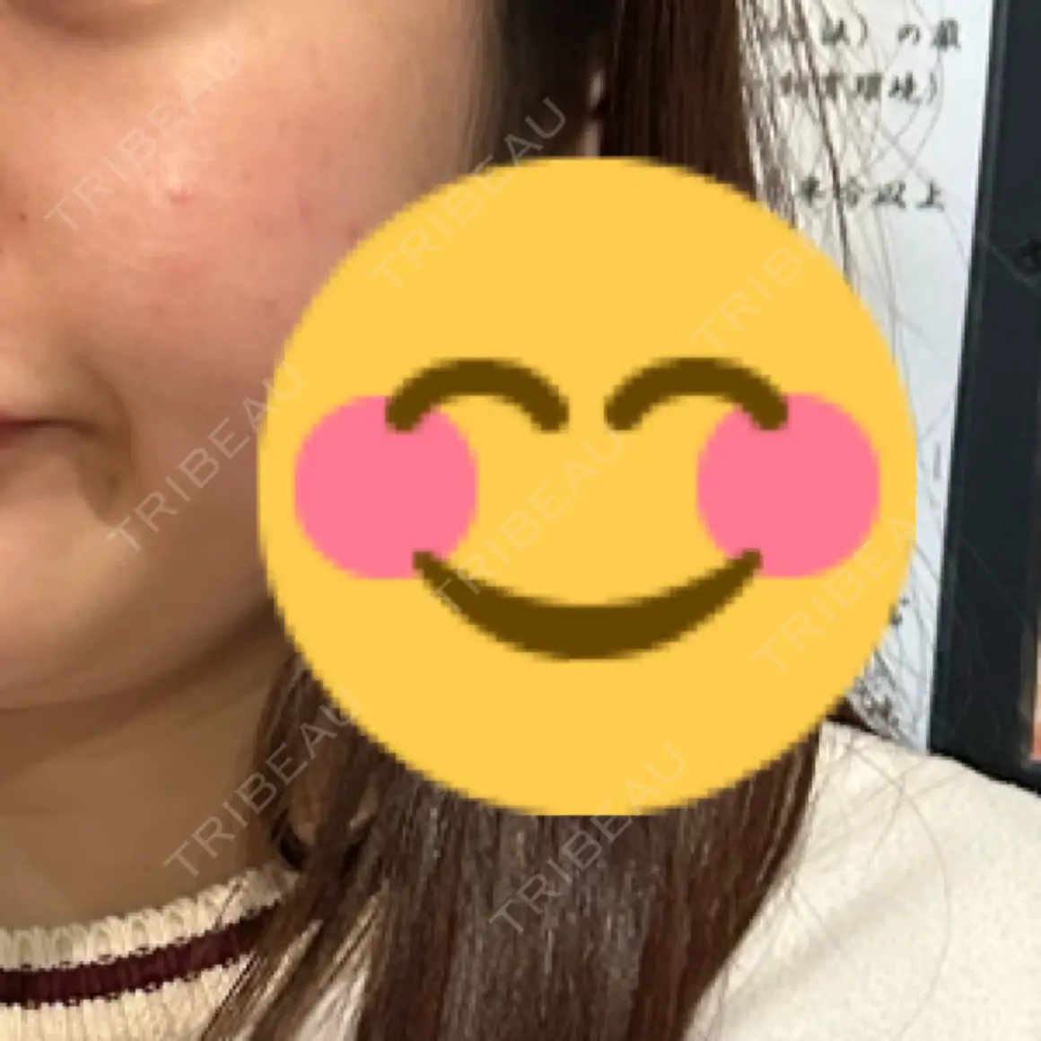 肌育注射（ジュベルックなど） シェリークリニック 福岡院 AFTER