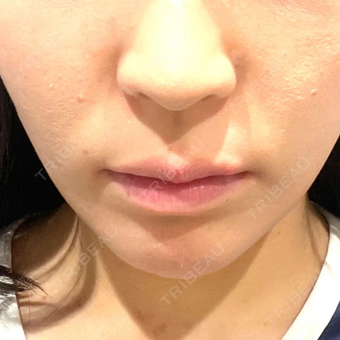糸リフト / 脂肪吸引（顔） / 脂肪吸引注射（顔） ziz CLINIC AFTER
