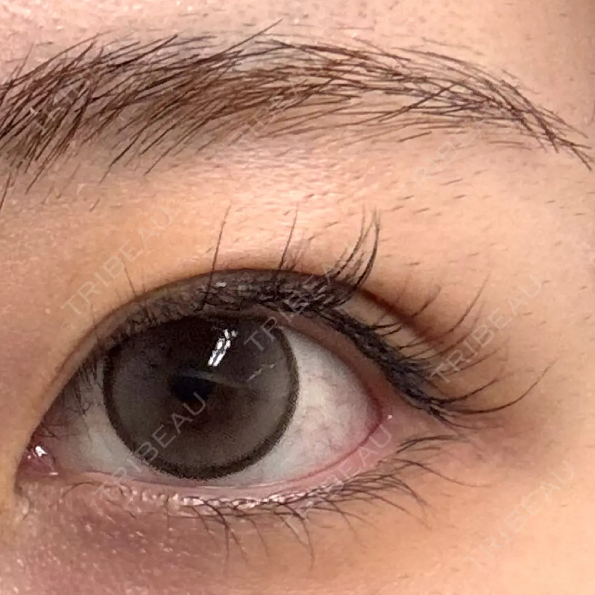 ヒアルロン酸注入（涙袋） フィラークリニック 渋谷院 AFTER