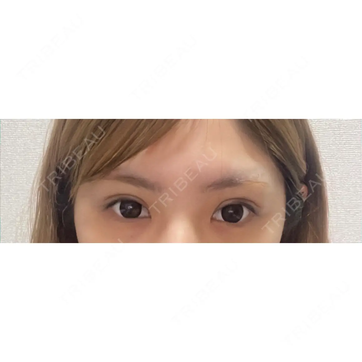 目頭切開 PRO CLINIC プロクリニック 銀座院 AFTER