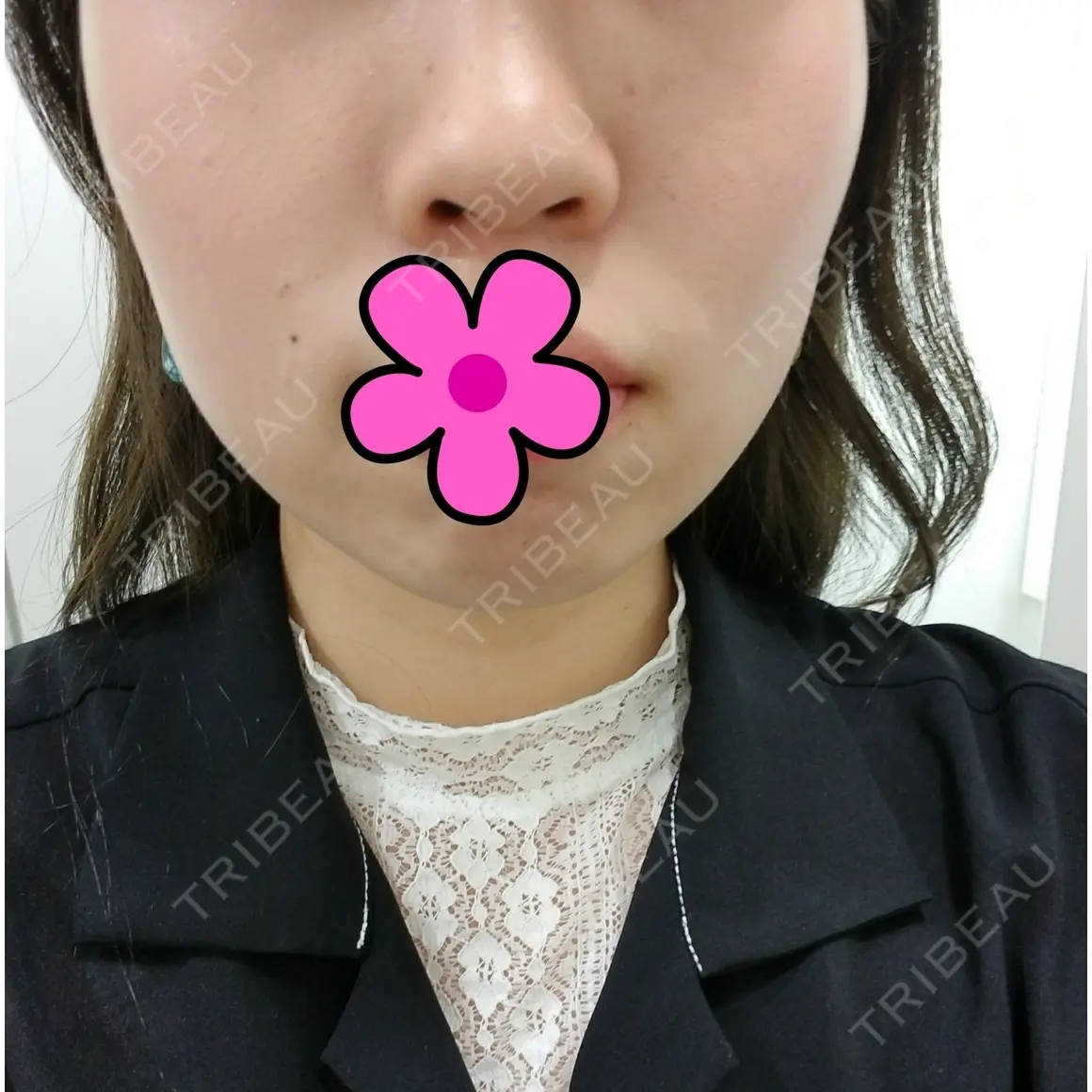 ボトックス（エラ・小顔） 湘南美容クリニック 新宿南口院 AFTER