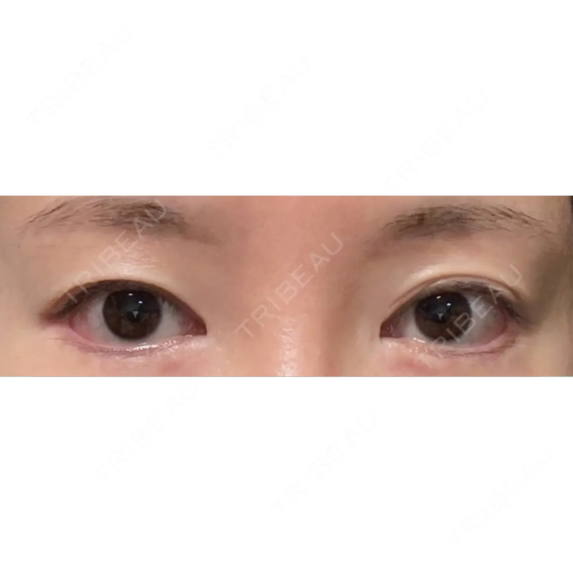 蒙古ひだ形成 銀座マイアミ美容外科 AFTER