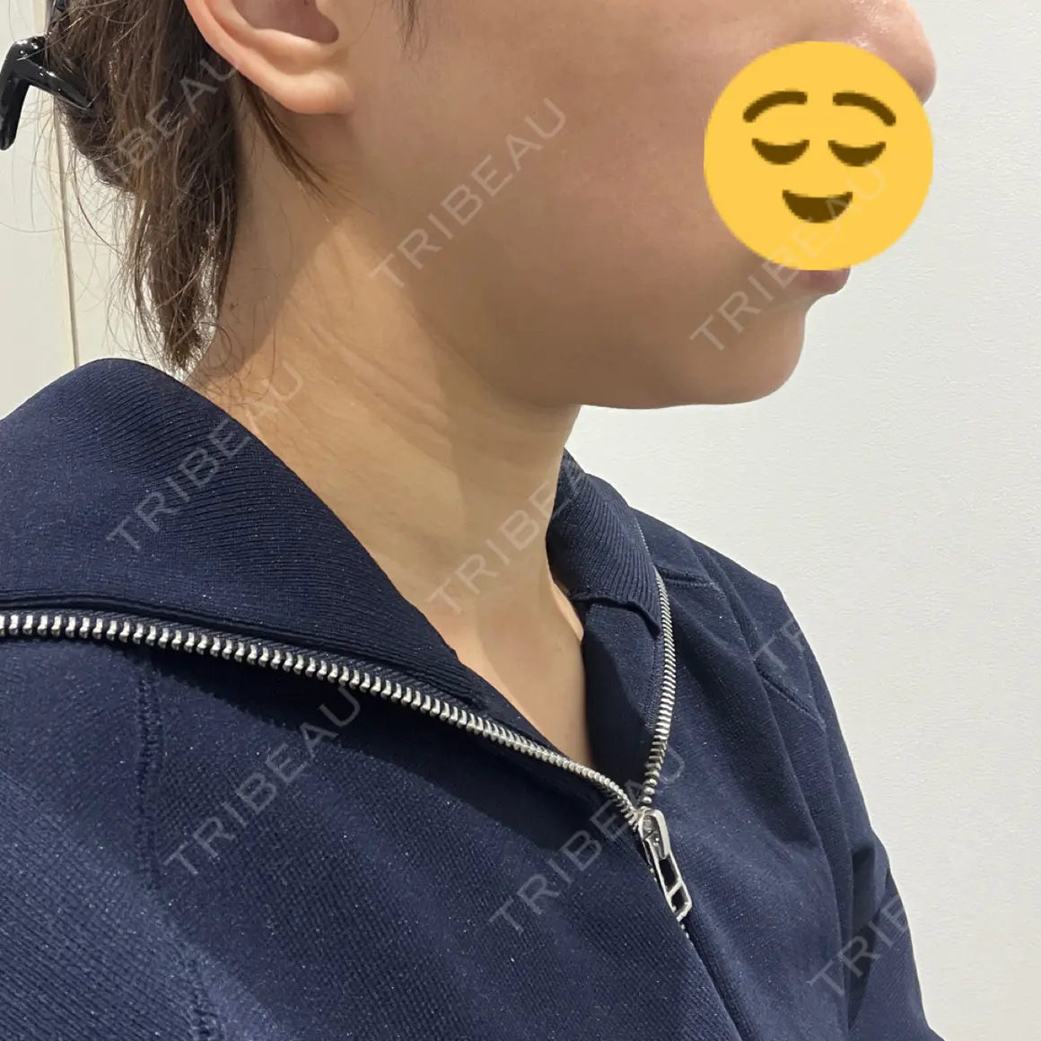 ハイフ（顔） WellnessPlus Clinic 【ウェルネスプラスクリニック】 AFTER