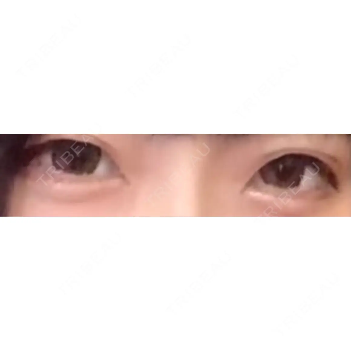 目頭切開 Stand by Beauty Clinic AFTER