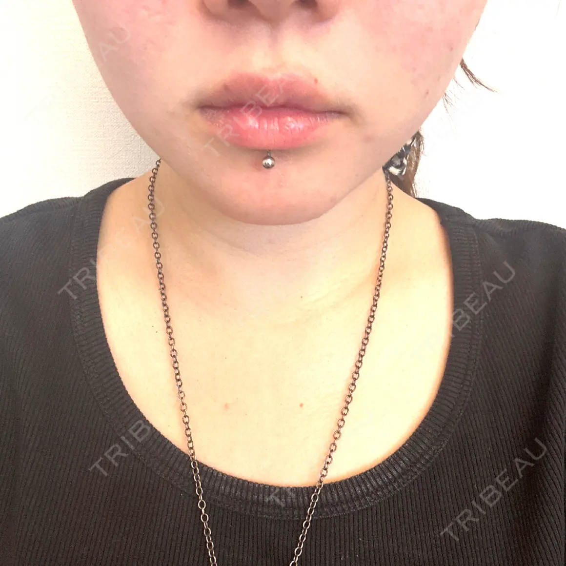 ボトックス（エラ・小顔） THE FIRST CLINIC 多摩センター院 AFTER
