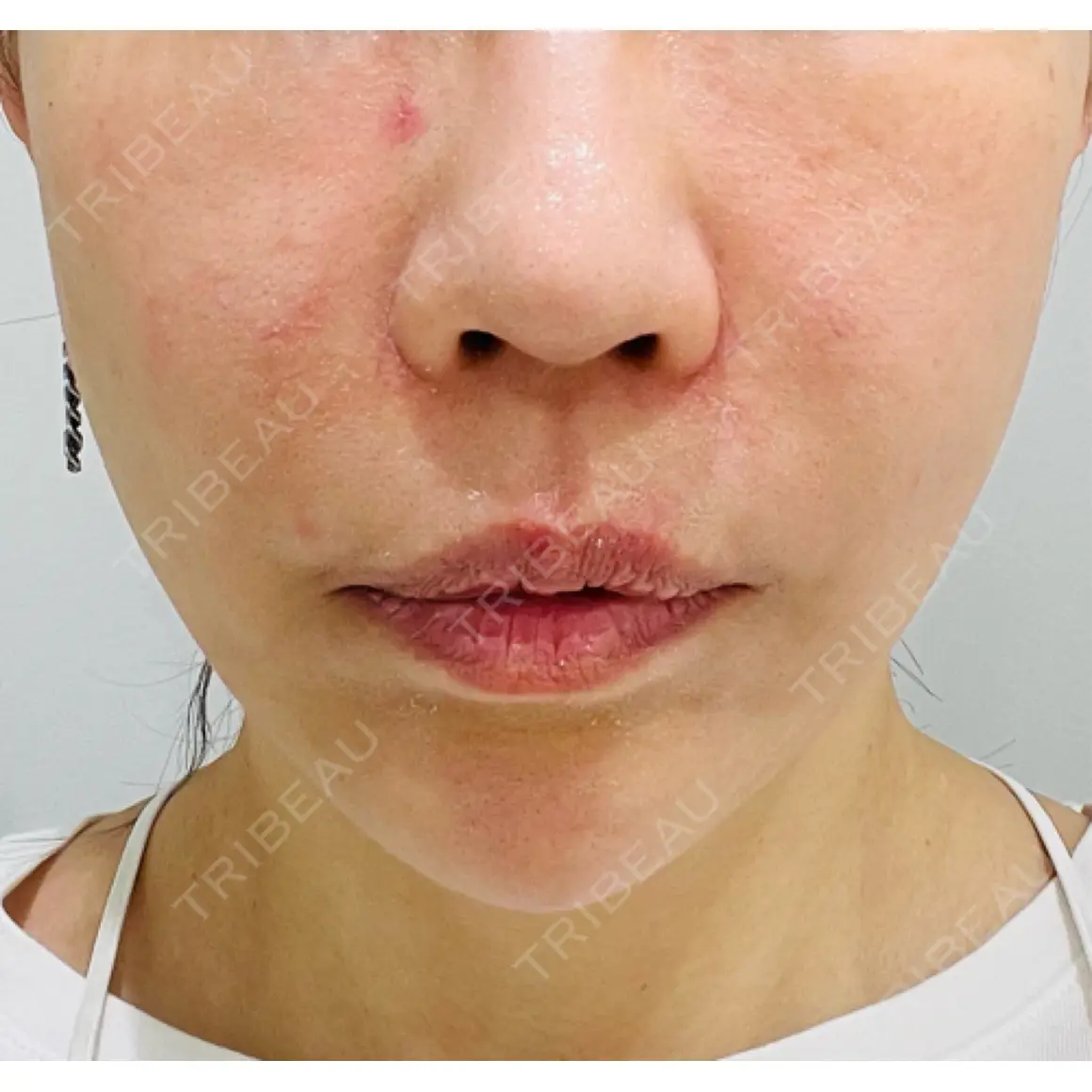 ハイフ（顔） WellnessPlus Clinic 【ウェルネスプラスクリニック】 AFTER