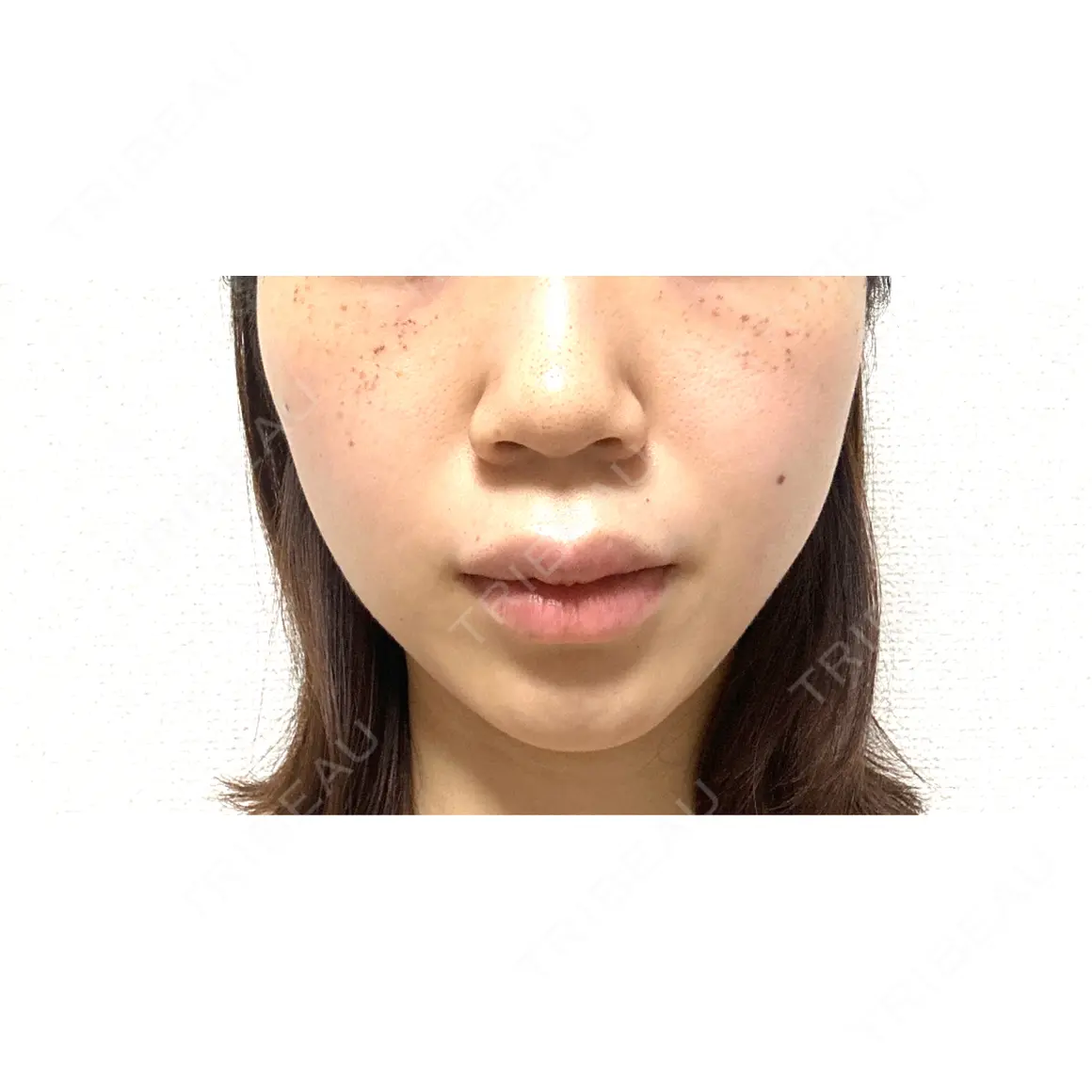 毛穴洗浄（ハイドラフェイシャルなど） / ルメッカ CZEN CLINIC 銀座院 AFTER