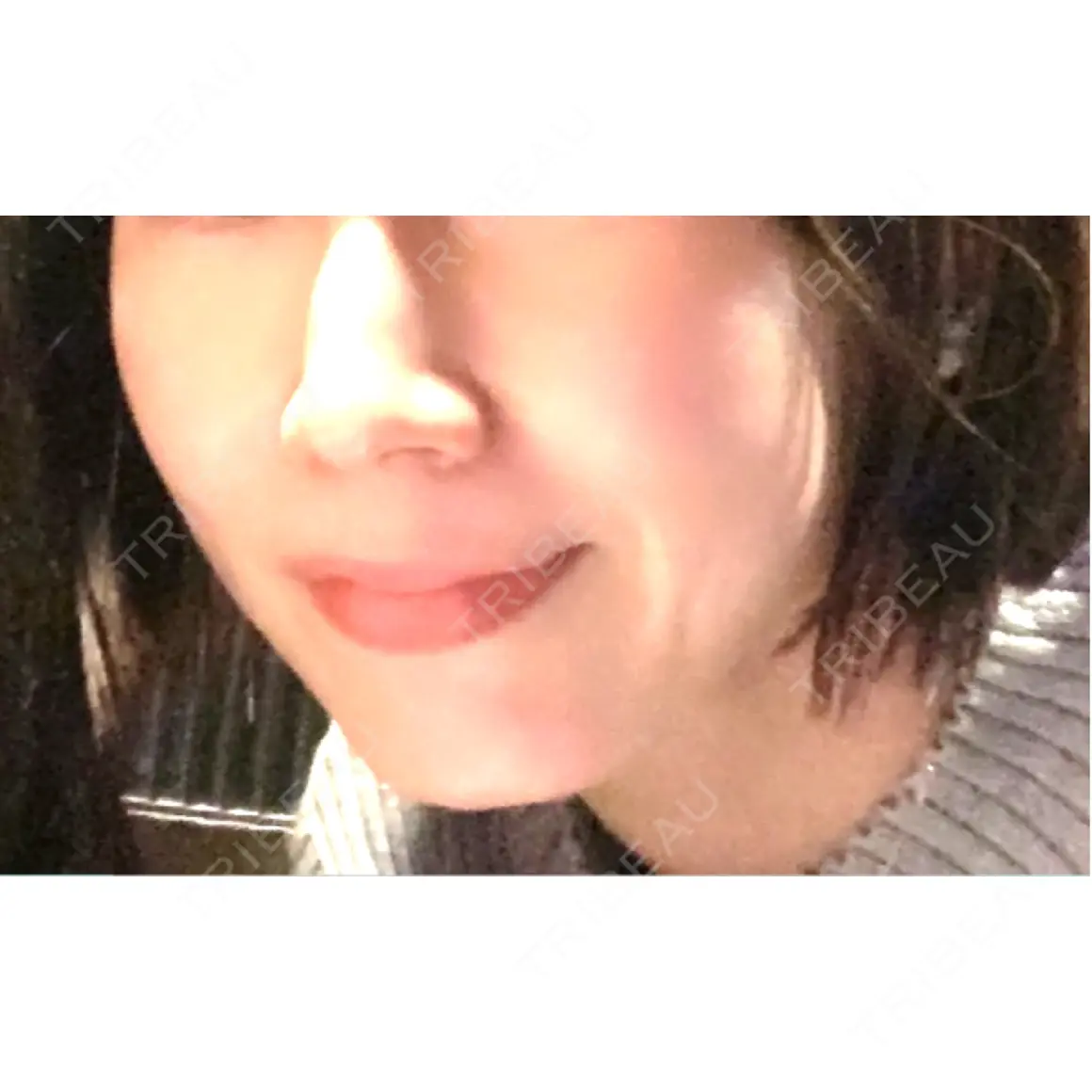 ヒアルロン酸注入（頬） / ボトックス（目尻） / その他（口元） フィラークリニック 福岡院 AFTER