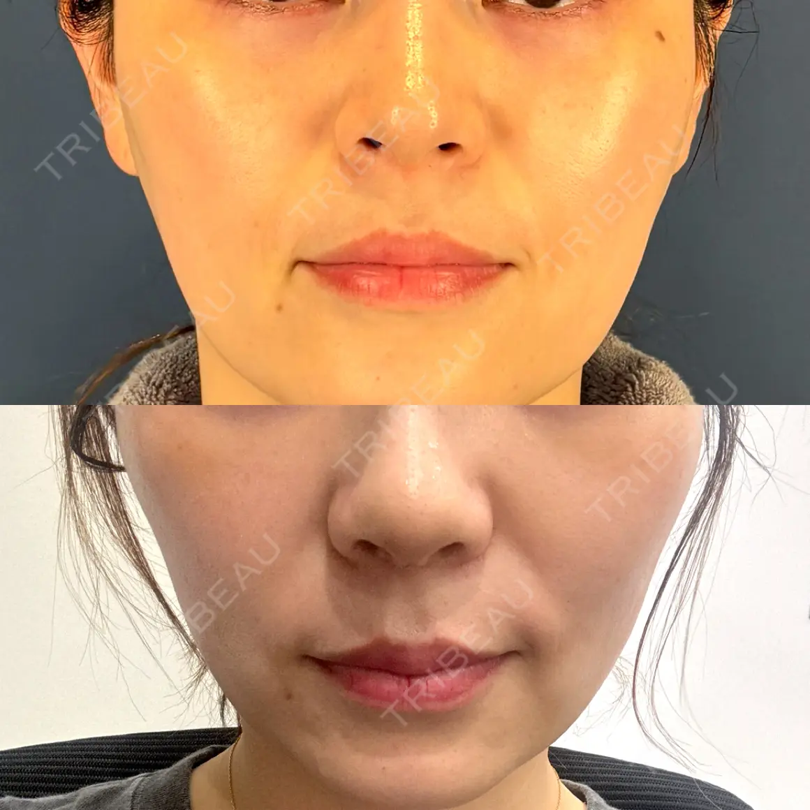 鼻尖形成（切開） / 鼻中隔延長（切開） / 軟骨移植 / 鼻孔縁下降 / 鼻翼基部形成（貴族手術） LIVIN CLINIC AFTER