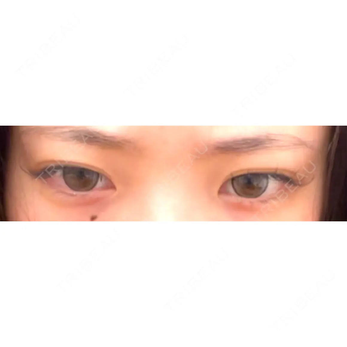 ヒアルロン酸注入（涙袋） フィラークリニック 大阪心斎橋院 AFTER