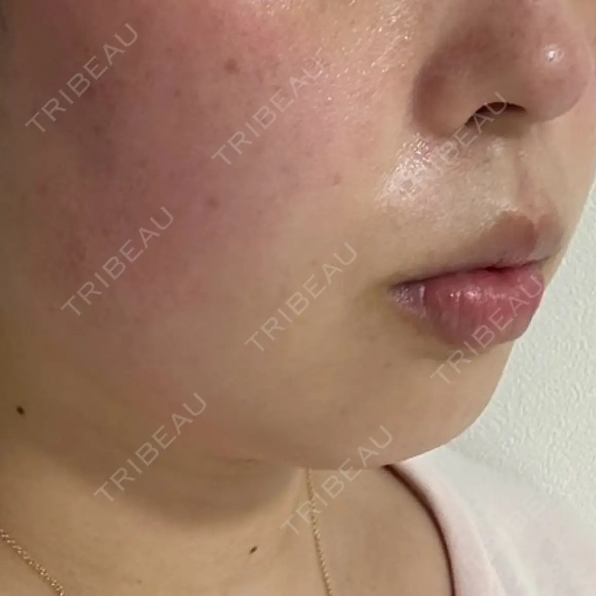 糸リフト / 脂肪吸引（顔） / あご下筋肉縛り / その他（輪郭） セギム美容整形外科 AFTER