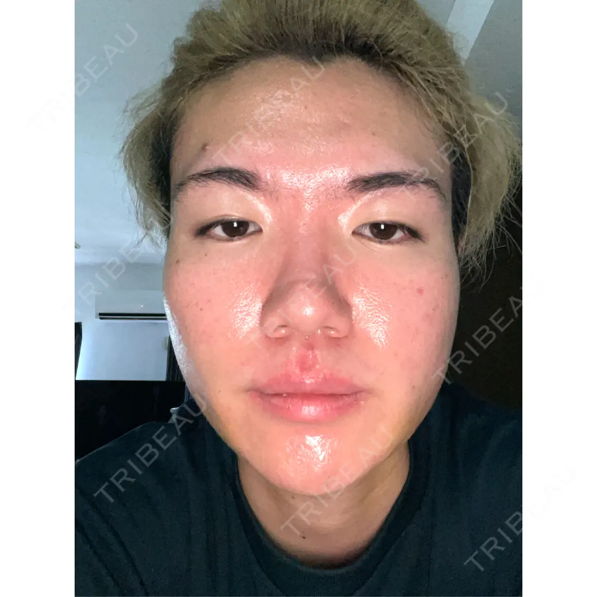 糸リフト / 脂肪吸引（顔） / ボトックス（エラ・小顔） MEMOTO CLINIC 名古屋 AFTER