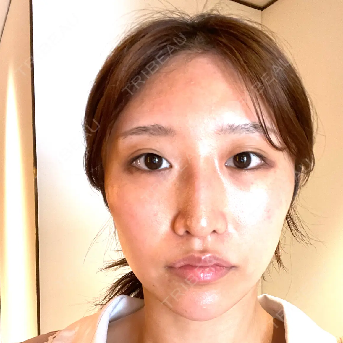 二重切開 / 眼瞼下垂（切開） / 上まぶたたるみ取り / 上まぶたの脂肪取り オーキッド美容クリニック東京御徒町 AFTER