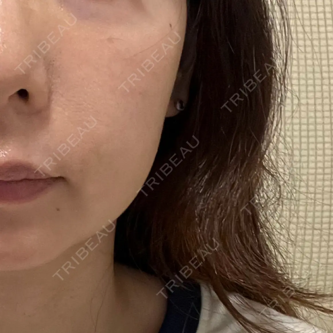 ルメッカ ルラ美容クリニック 千葉院 / ルラスキンクリニック 千葉院 AFTER