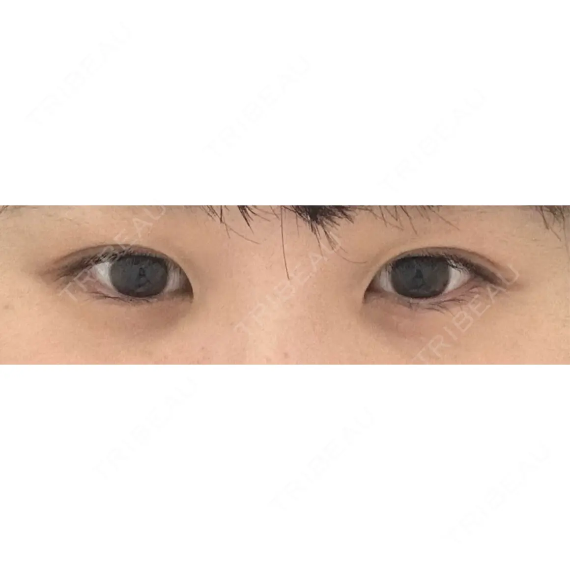 二重埋没 / 目頭切開 / 上まぶたの脂肪取り 9BeautyClinic AFTER