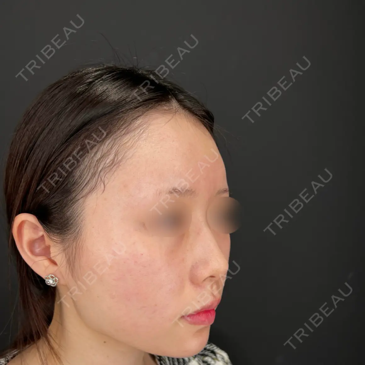 ヒアルロン酸注入（鼻） HAAB×DREAM BEAUTY CLINIC 大阪梅田院 AFTER