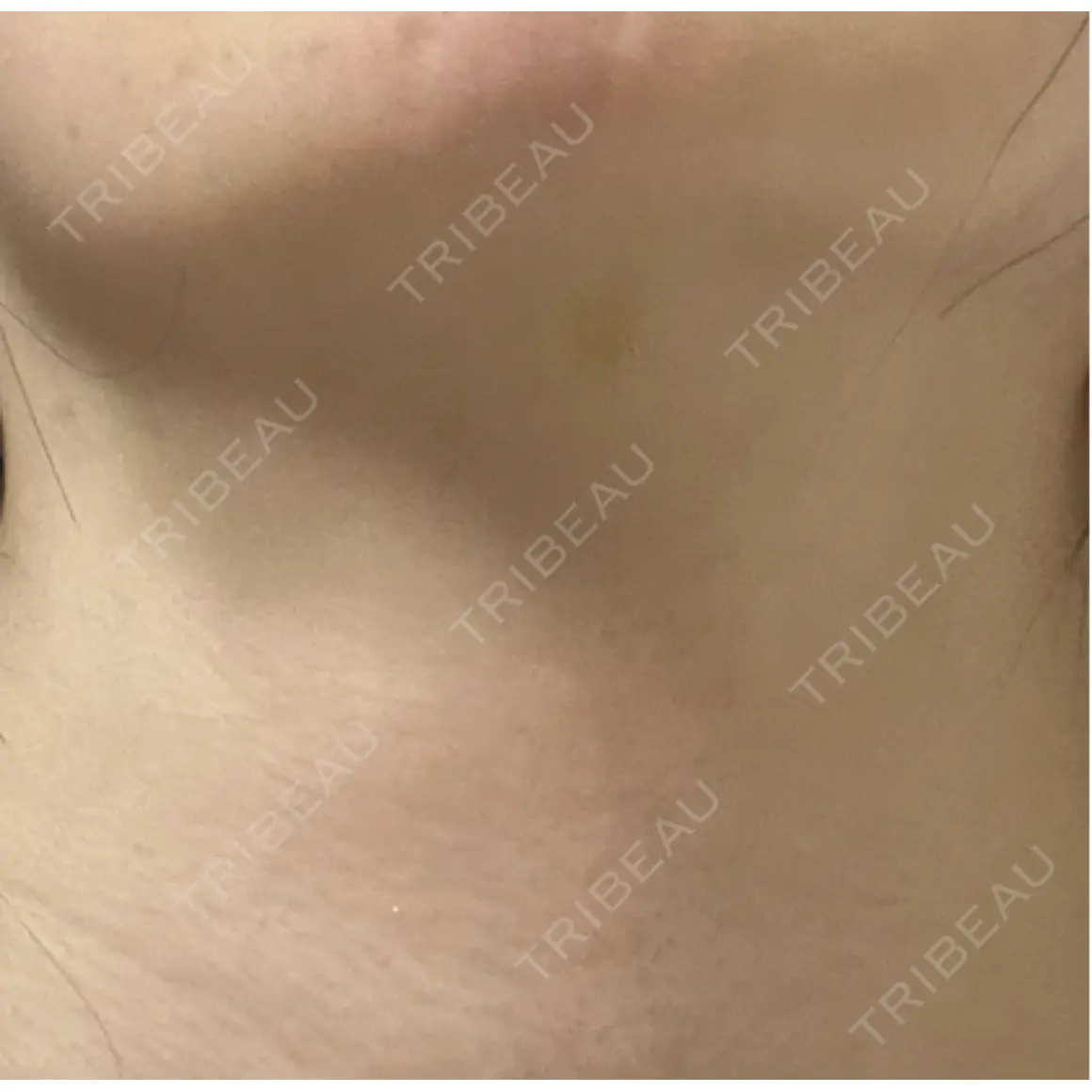 ボトックス（首） PRO CLINIC プロクリニック 銀座院 AFTER
