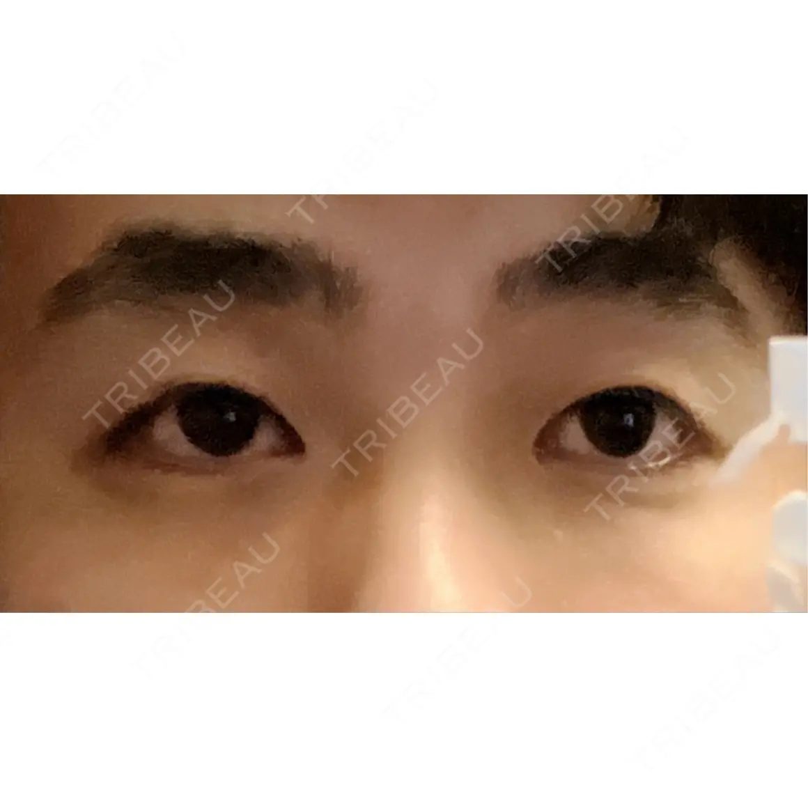 二重切開 / 眼瞼下垂（切開） / 上まぶたたるみ取り / 上まぶたの脂肪取り オーキッド美容クリニック東京御徒町 AFTER