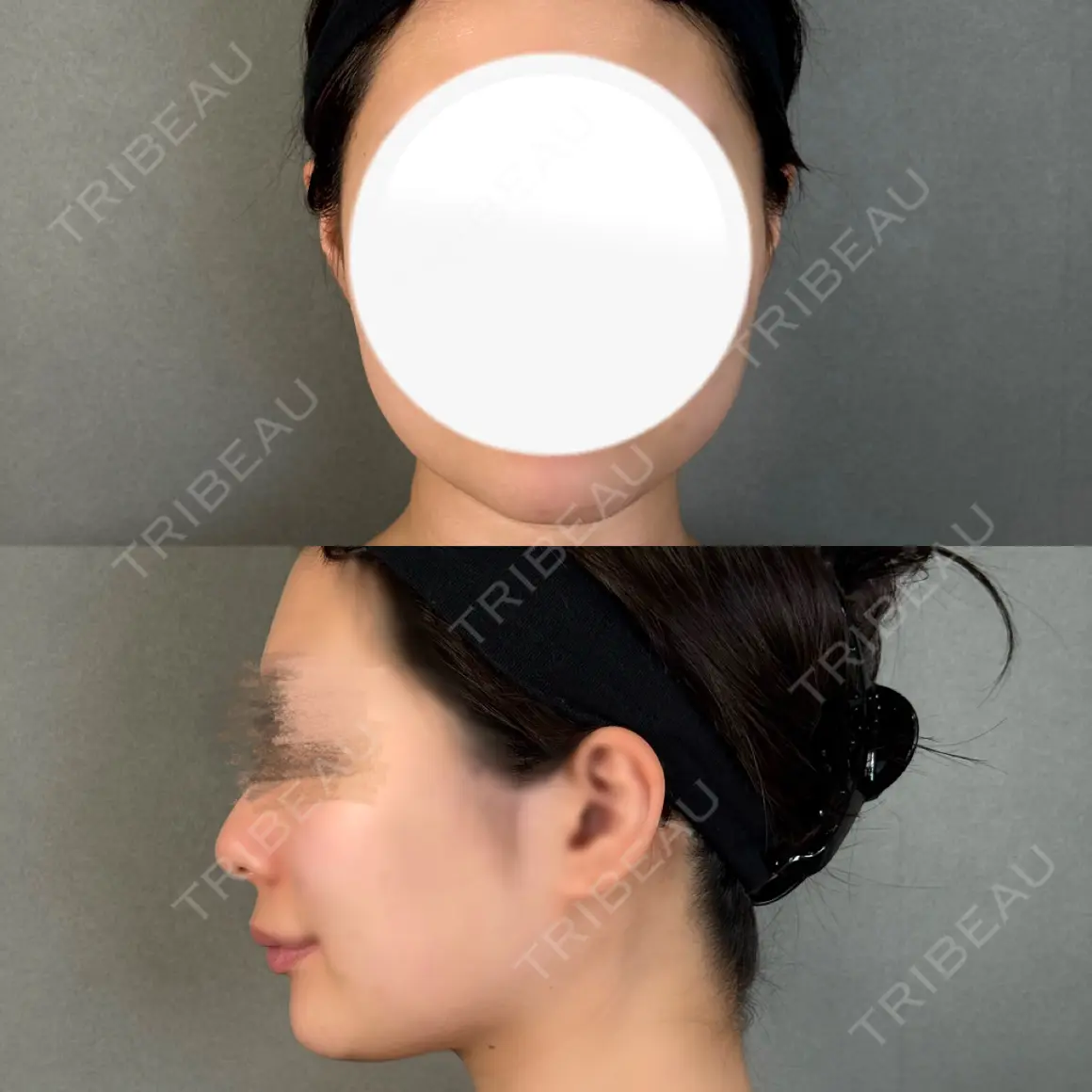 糸リフト / バッカルファット除去 / 脂肪吸引（顔） / ジョールファット除去 / ボトックス（あご） / ボトックス（エラ・小顔） アリエル美容クリニック 大宮院 AFTER