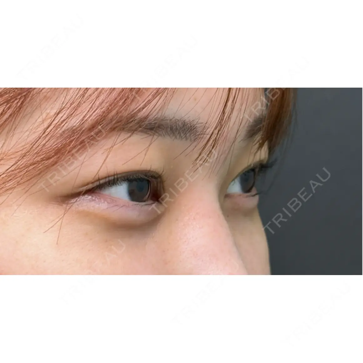 二重埋没 / タレ目形成・グラマラスライン（切開） / 脂肪吸引注射（顔） eクリニック 横浜みなとみらい院 AFTER