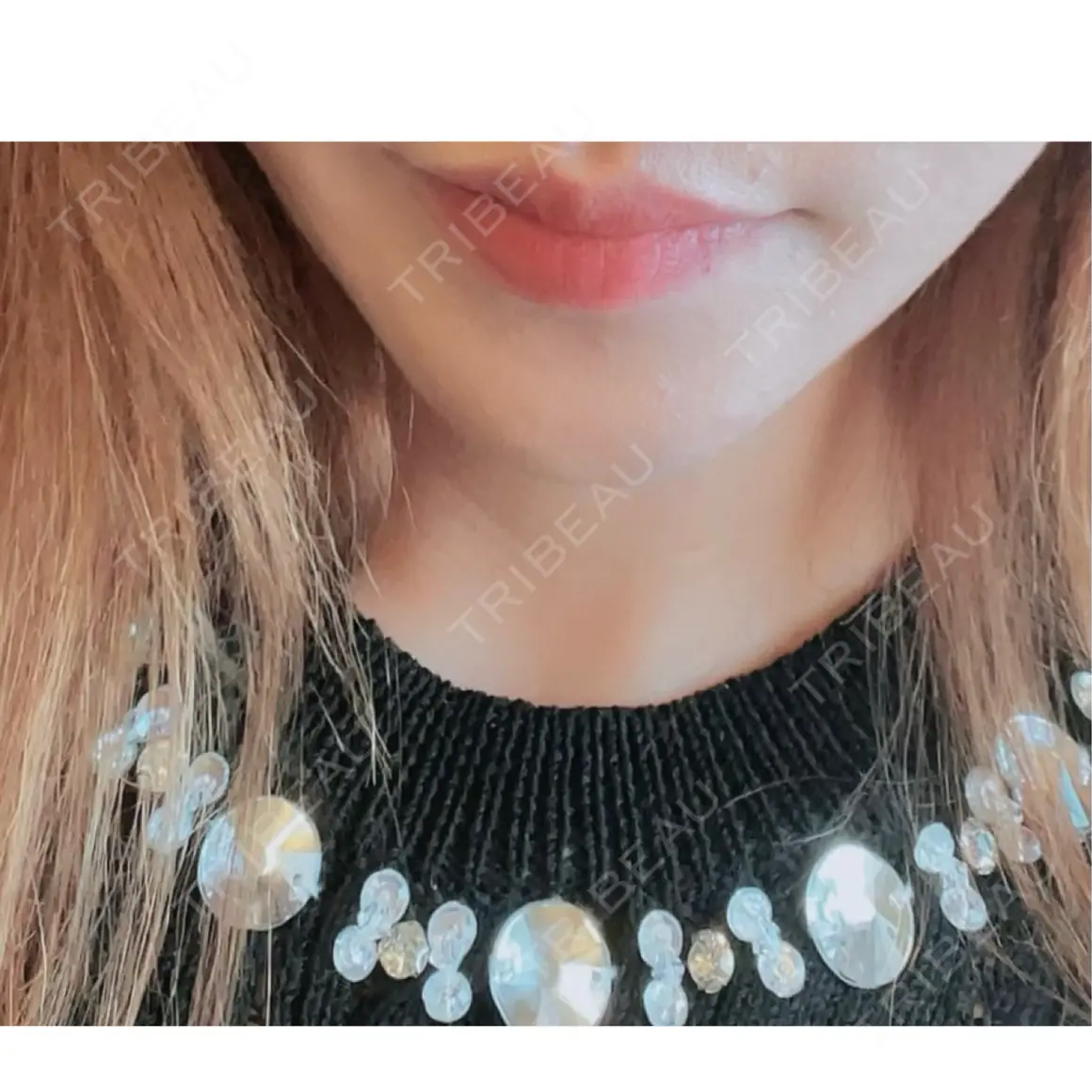 その他（口元） GRACIA clinic 【グラシアクリニック】 AFTER
