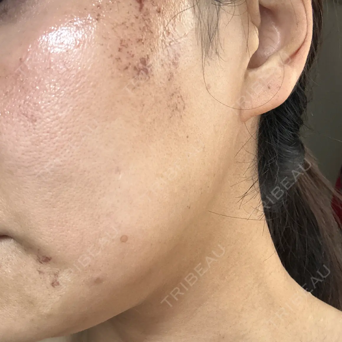 医療脱毛（ワキ） / ルメッカ ルラ美容クリニック 広島院 AFTER