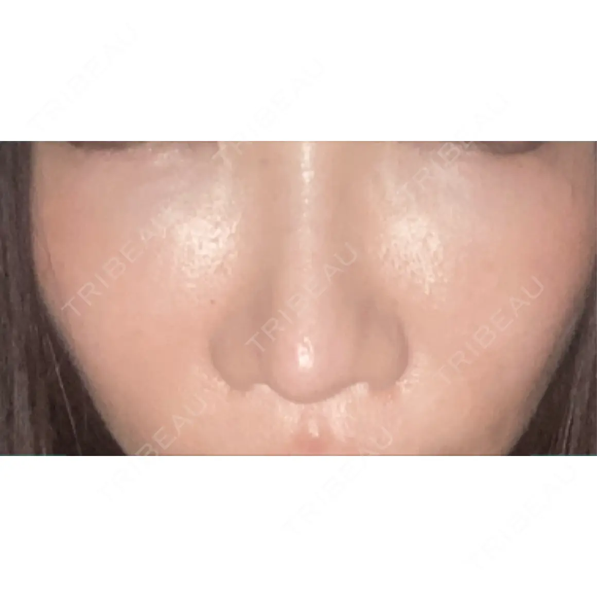その他（目元） ブルームクリニック（BLOOM CLINIC） AFTER