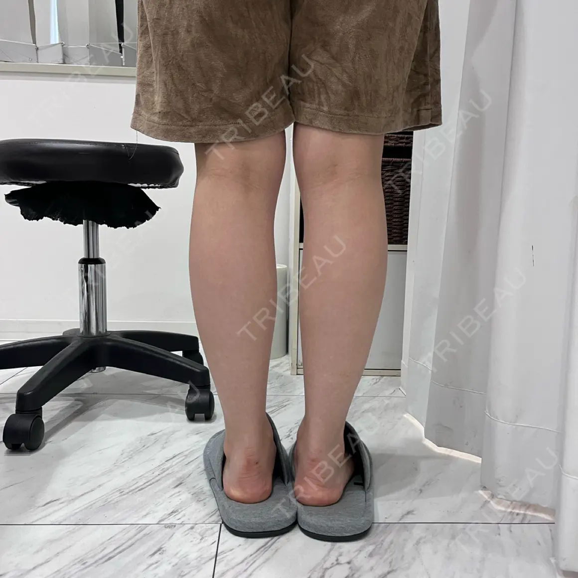 ボトックス（ふくらはぎ） 椿クリニック 心斎橋院 AFTER