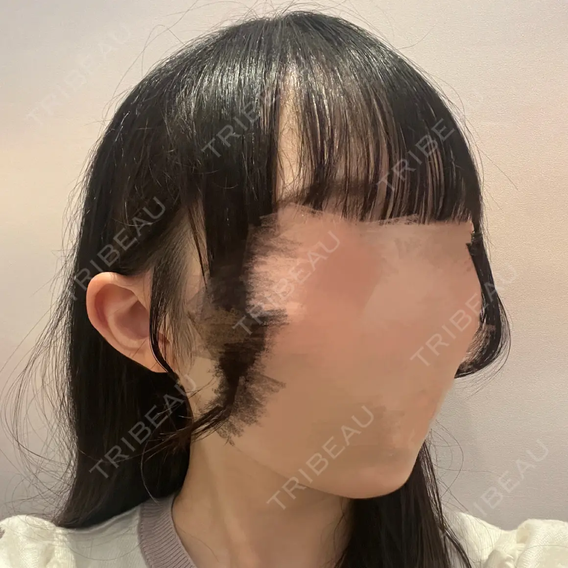 ボトックス（エラ・小顔） eクリニック 名古屋院 AFTER
