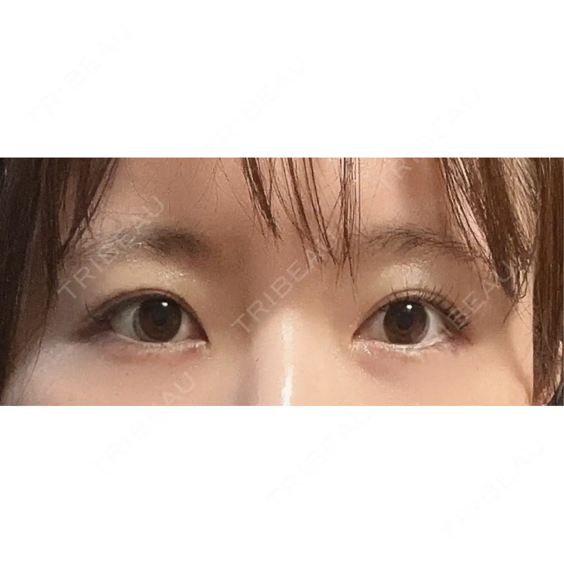 ヒアルロン酸注入（涙袋） Leap beauty clinic AFTER