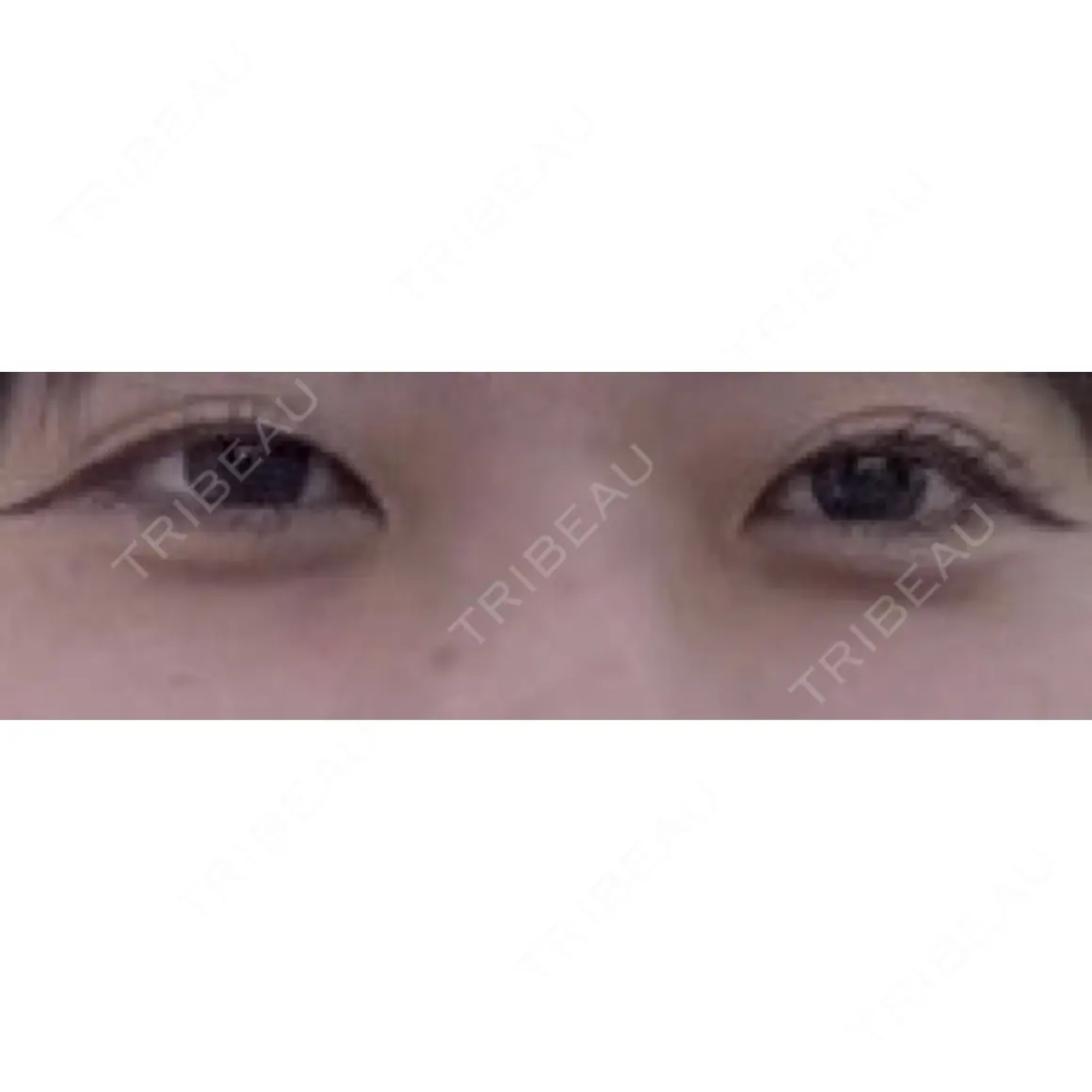 二重切開 / 眼瞼下垂（切開） オーキッド美容クリニック東京御徒町 AFTER
