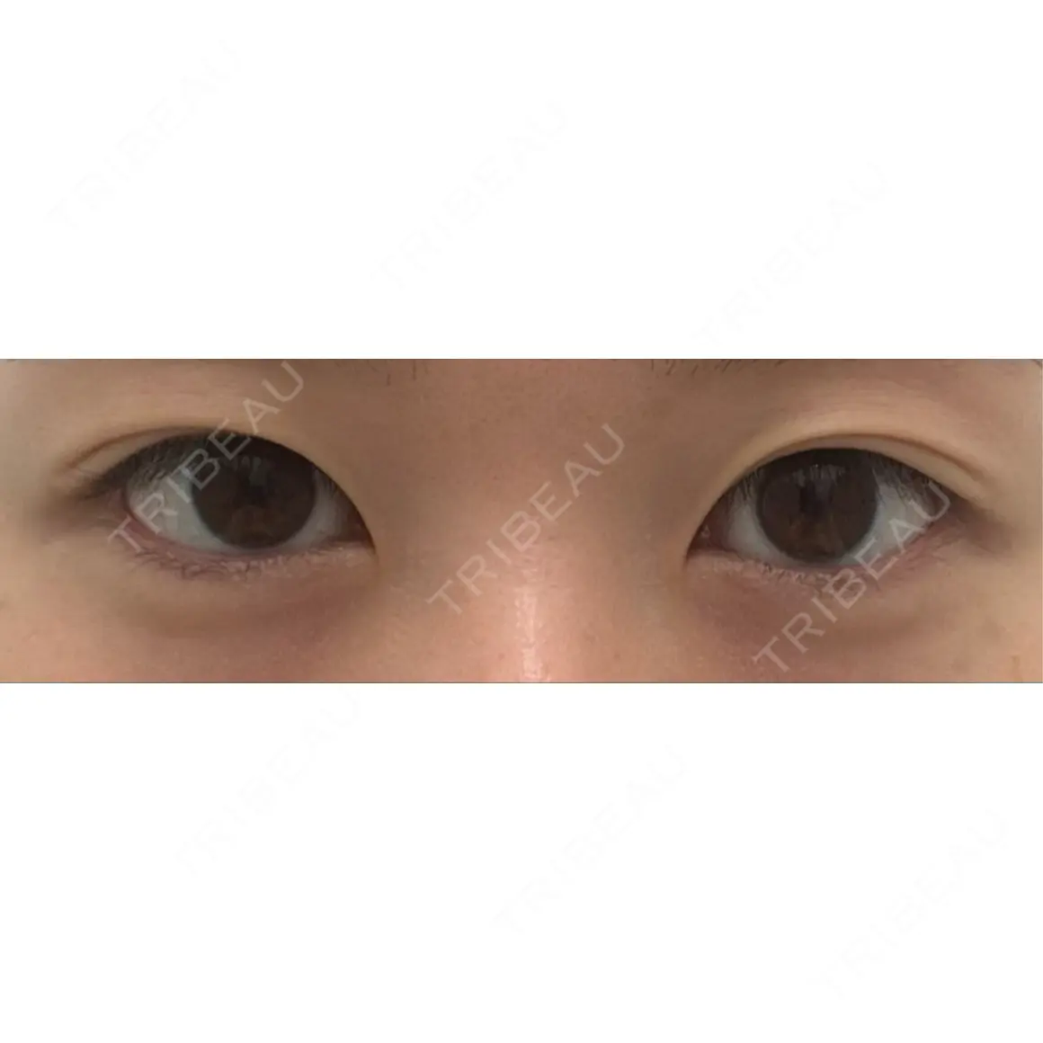二重埋没 湘南美容クリニック 池袋東口院 AFTER