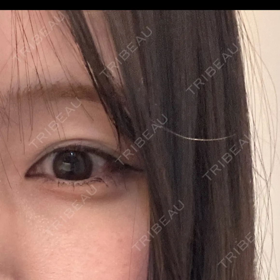 二重埋没 ROOTS Clinic AFTER