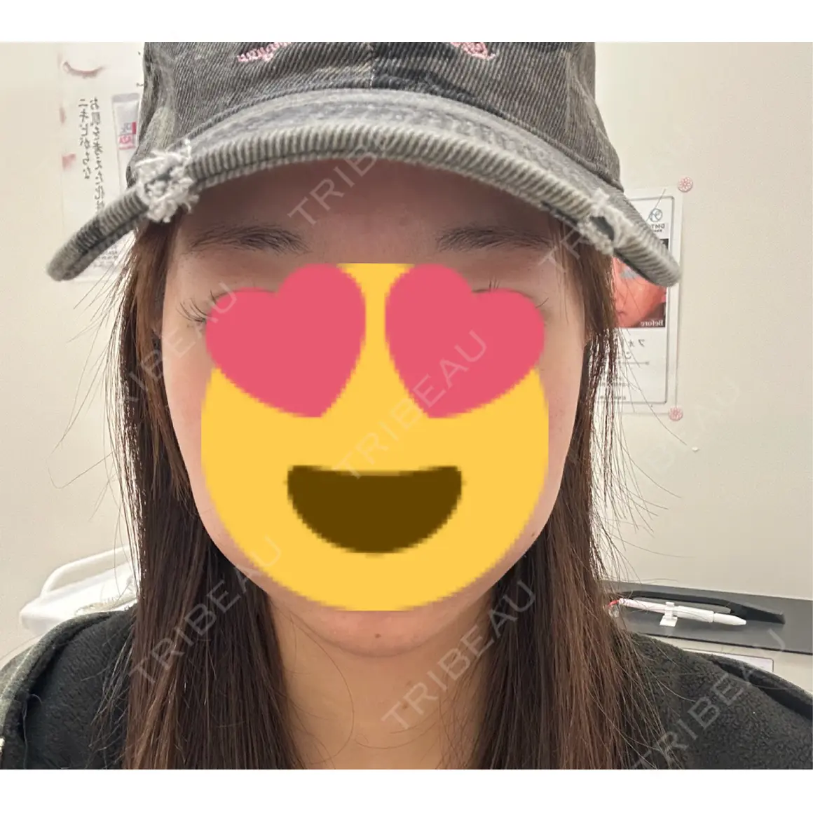 ボトックス（エラ・小顔） / ボトックス（肩） DMTC美容皮膚科 大宮院 AFTER