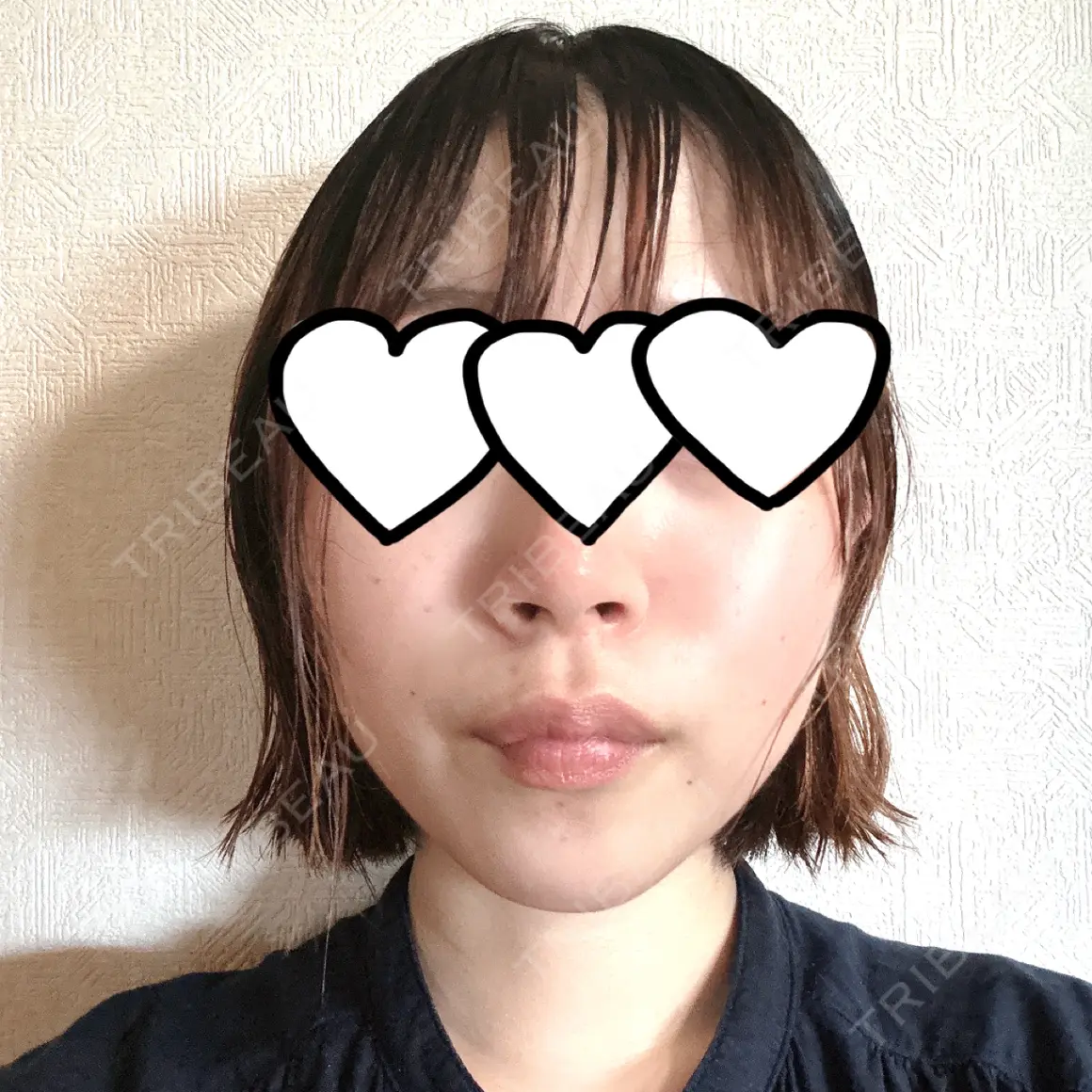 脂肪吸引（顔） ルラ美容クリニック 上野院 AFTER