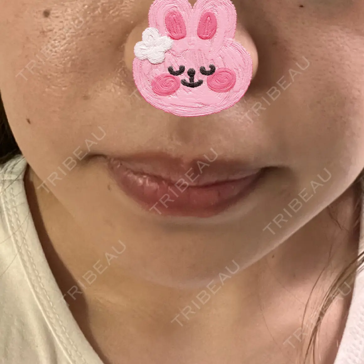 ヒアルロン酸注入（唇） / ボトックス（口角） / ヒアルロン酸注入（鼻翼基部） ルラ美容クリニック 大阪本院 AFTER