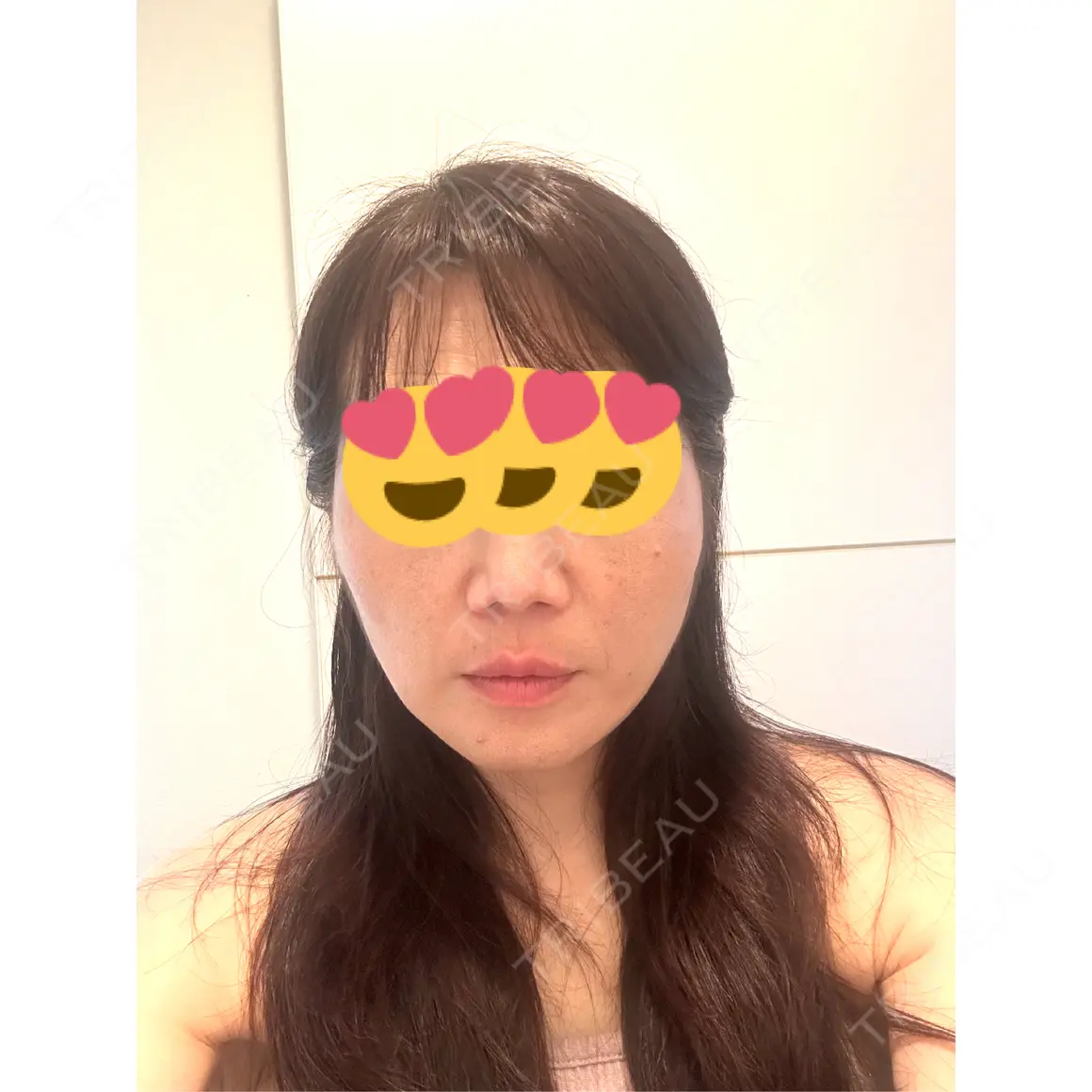 糸リフト / ヒアルロン酸注入（頬） ルラ美容クリニック 上野院 AFTER