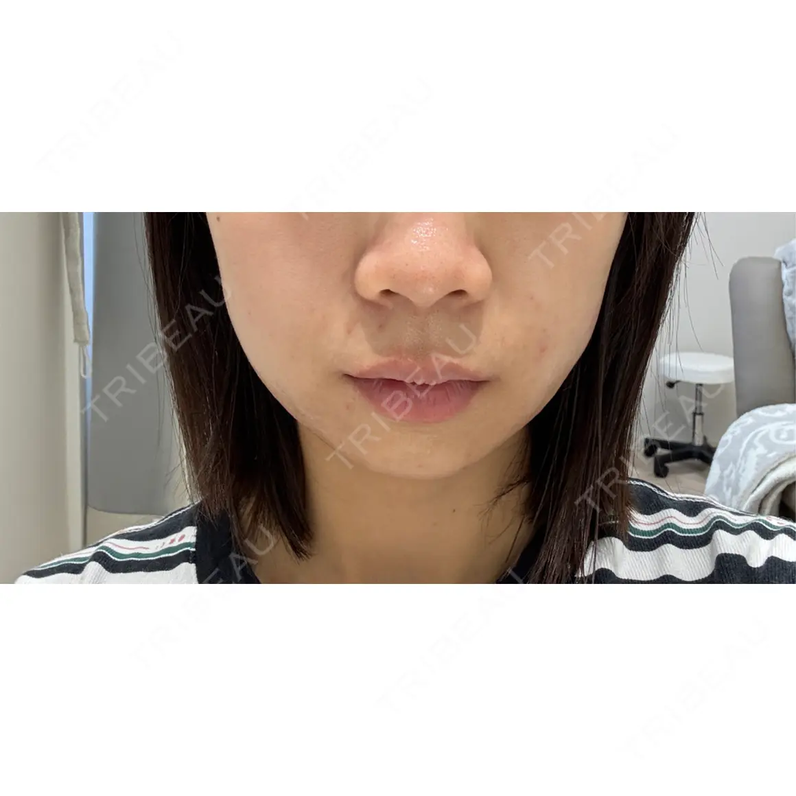 糸リフト / ハイフ（顔） 銀座リシェスクリニック AFTER